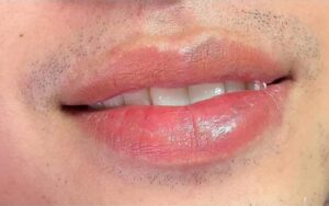 Khử thâm môi nam có giúp cải thiện nếp nhăn và da khô không?