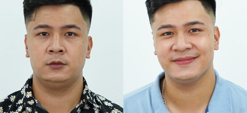 Khử thâm môi nam có thay đổi tướng mạo 