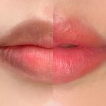 Khử thâm môi có đau không?