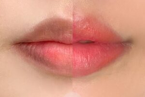 Khử thâm môi là gì?