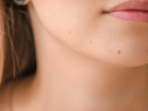 Tẩy nốt ruồi bôi gì cho hết sẹo?