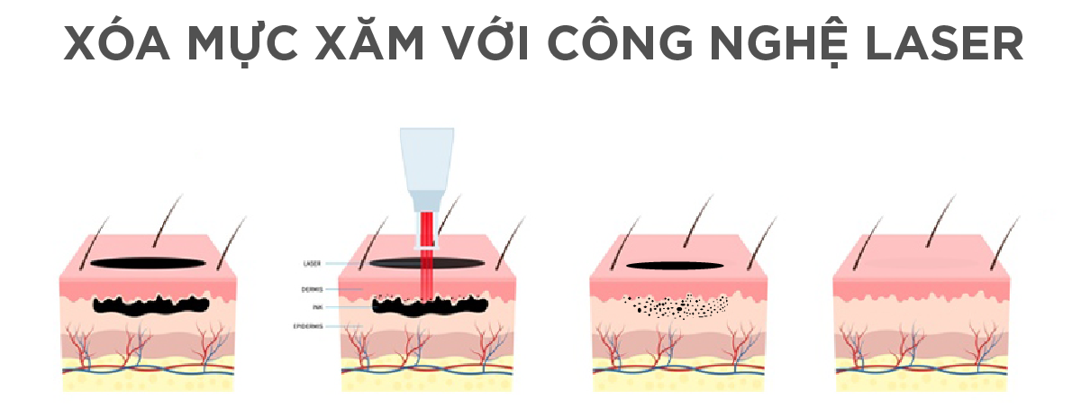 Công nghệ laser mới giúp xoá phun mí lỗi ra sao? 2 may laser xoa xam cong nghe cao e1760023914408