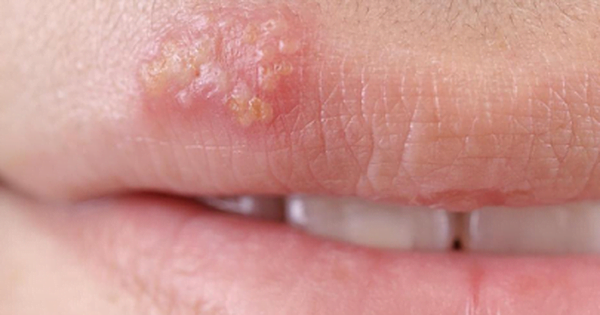 Phun môi cho người từng bị herpes (mụn rộp môi) 1 Phun môi cho người từng bị herpes (mụn rộp môi)