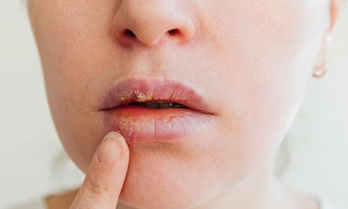 Dấu hiệu môi khử xong bị khô Dấu hiệu môi khử xong bị khô