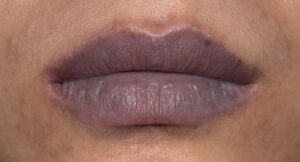 Môi thâm do di truyền – đừng lo, vẫn có thể xử lý được!