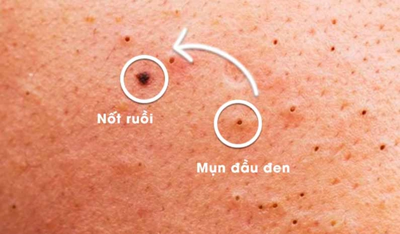 Mụn để lâu không nặn có thành nốt ruồi không? 1 Mụn để lâu không nặn có thành nốt ruồi không?