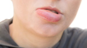 Khử thâm môi nam có bị sưng không?