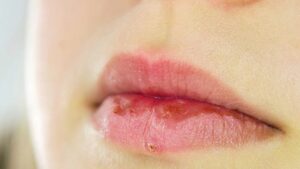 Khử thâm môi bị khô, bong tróc sau khi làm