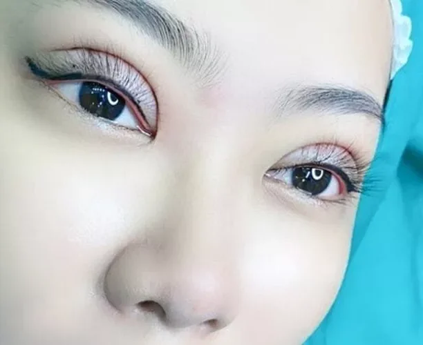 Vì sao nhiều người chọn phun mí sau khi cắt mí? 5 nhung hinh anh cat mi mat 5 1 e1759826755227