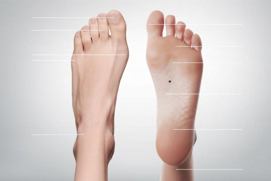 Nốt ruồi ở bàn chân mang ý nghĩa gì và cách tẩy an toàn 1 Nốt ruồi ở bàn chân là sự tập hợp của các tế bào sắc tố trên da