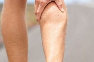 Nốt ruồi ở bắp chân là hiện tượng da liễu bình thường ở cơ thể