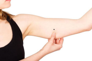 Nốt ruồi ở bắp tay thường lành tính và an toàn cho sức khỏe