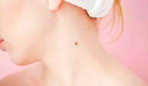 not ruoi son la gi da noi nhieu not ruoi son co sao khong 202304050712436190 1698726662