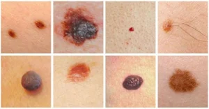 Nốt ruồi bẩm sinh có tẩy được không?