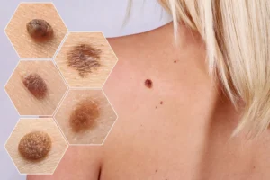 Nốt ruồi báo ung thư là hoàn toàn có thật!