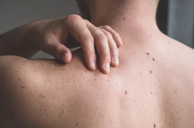 Nốt ruồi bị ngứa là dấu hiệu gì về sức khỏe? 1 Nốt ruồi có thể dẽ bị ngứa nếu bạn mắc bệnh chàm