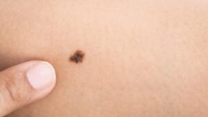 Nốt ruồi có thể xuất hiện đơn lẻ hoặc tập trung thành từng nhóm