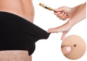 Nốt ruồi ở dương vật có thể là dấu hiệu của một bệnh lý nghiêm trọng.