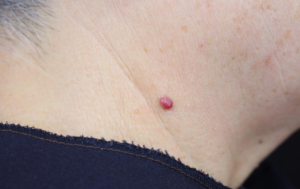 Nốt ruồi son ở cổ đàn ông theo góc nhìn y khoa có ý nghĩa gì?