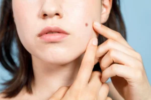 Nốt ruồi trên mặt có thể làm ảnh hưởng đến thẩm mỹ