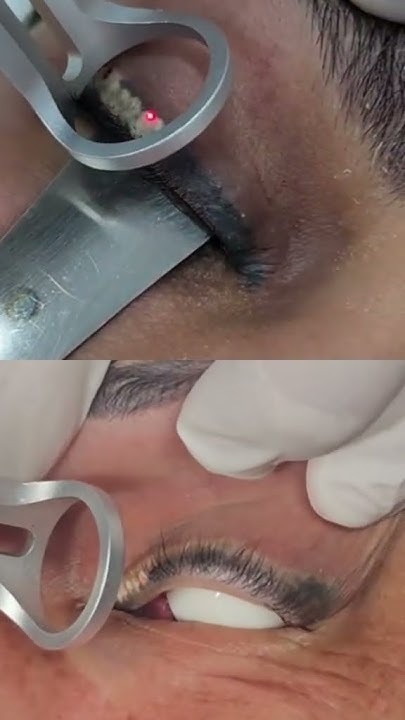 Công nghệ laser mới giúp xoá phun mí lỗi ra sao? 4 oar2