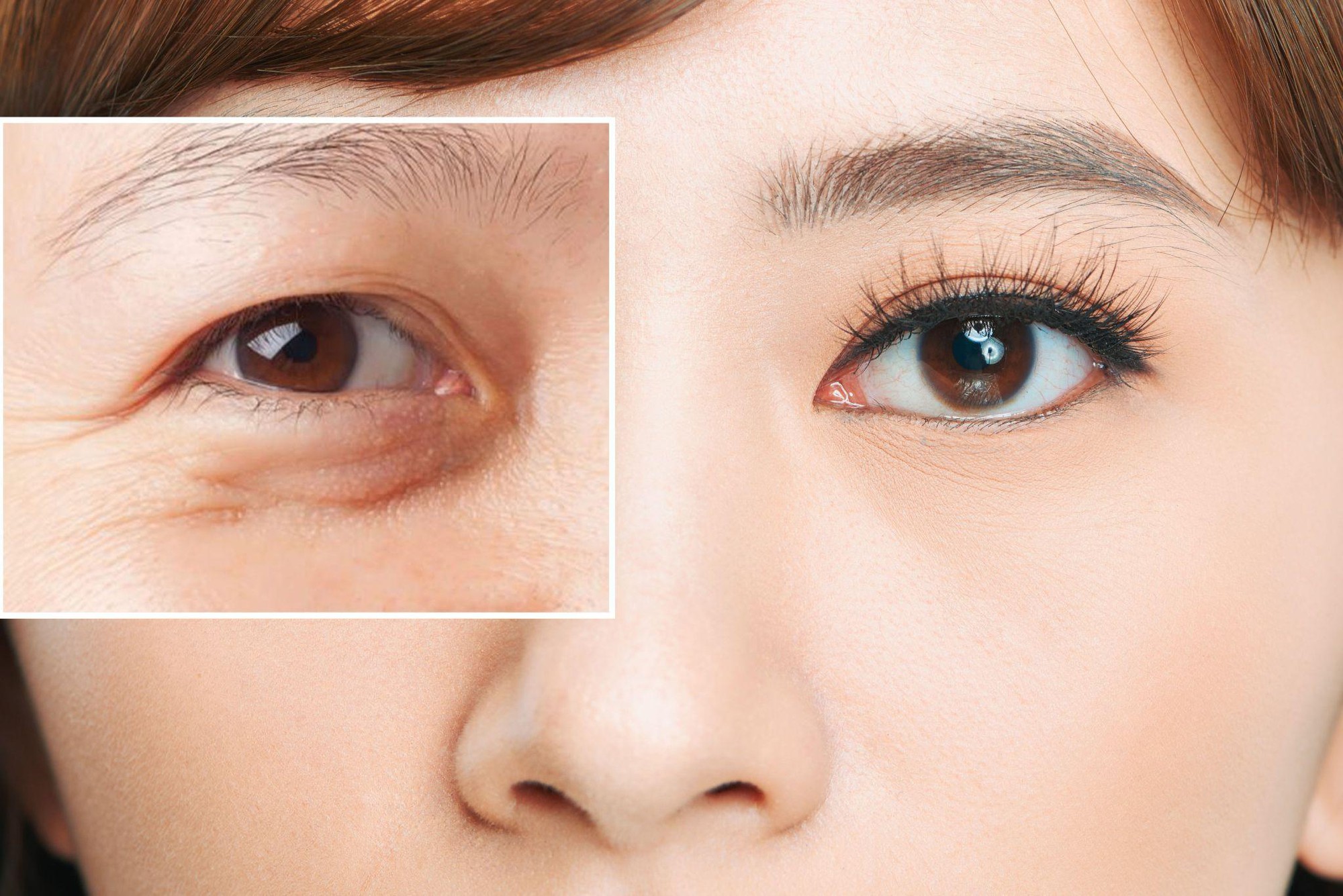 Phun mí và căng da vùng mắt – đồng thời nên làm cái nào trước sau?