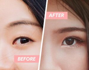 Phun mí có thể kết hợp với cắt mí không?