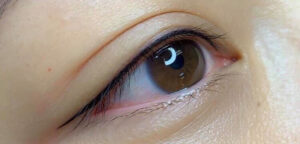 Phun mí có thể che khuyết điểm cho mắt lồi không?