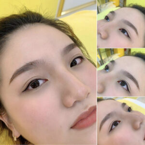 Phun mí có kén màu da không?