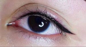 Vì sao phun mí nano lại ít sưng hơn các phương pháp cũ?