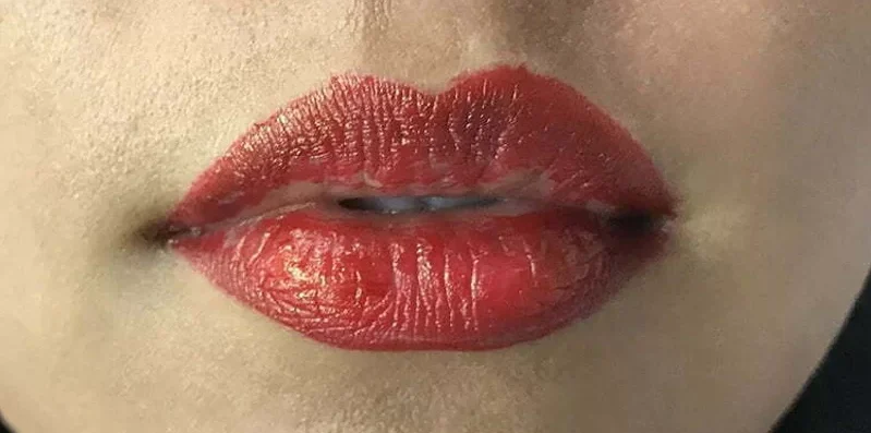 Da môi tái tạo kém sau phun – nguyên nhân và cách phục hồi