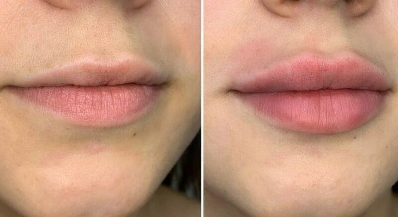 Môi trổ tím, xỉn đen – có thể xử lý bằng khử thâm được không? 3 Khử thâm môi Collagen cho nam là gì?