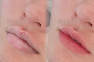 Khử thâm môi là gì?