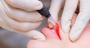 Phun môi bằng đầu kim Nano khác gì Micro?