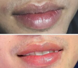 Khử thâm môi nam có đau không? 