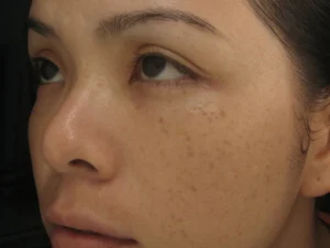 Tàn nhang là những điểm màu nâu và phẳng