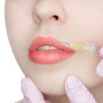 Tiêm filler môi có kiêng nước không? Cần lưu ý điều gì sau khi tiêm filler?