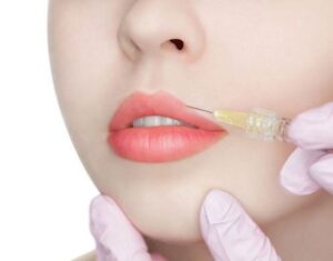 Tiêm filler môi có kiêng nước không? Cần lưu ý điều gì sau khi tiêm filler?