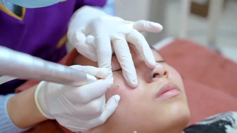Tẩy nốt ruồi bằng laser có hiệu quả và an toàn không? Tẩy nốt ruồi bằng laser có hiệu quả và an toàn không?