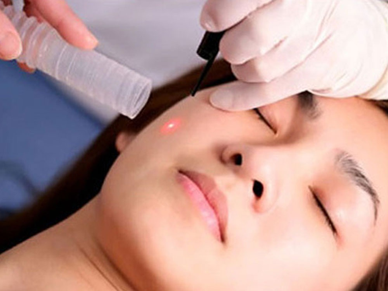 Tẩy nốt ruồi bằng tia laser giá bao nhiêu? 1 Tẩy nốt ruồi bằng laser không xâm lấn