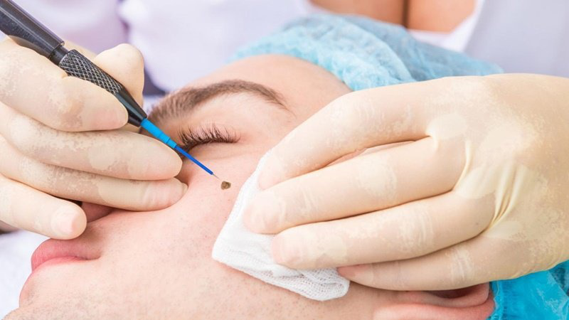 Tẩy nốt ruồi có được uống sữa không? Tẩy nốt ruồi kiêng ăn gì? 1 Tẩy nốt ruồi có được uống sữa không?