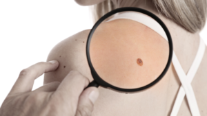 Tẩy nốt ruồi có mọc lại không?