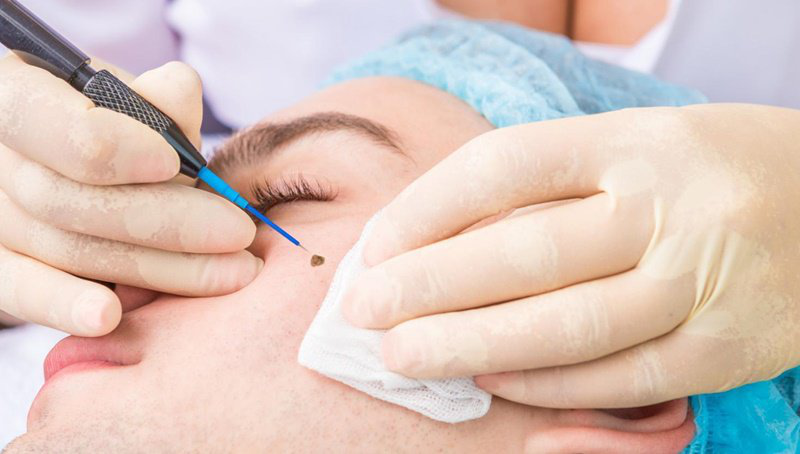 Tẩy nốt ruồi kiêng gì Tẩy nốt ruồi kiêng gì