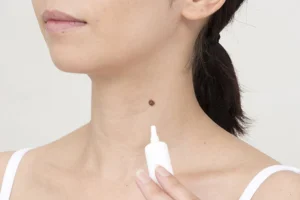 Chăm sóc da sau khi tẩy nốt ruồi