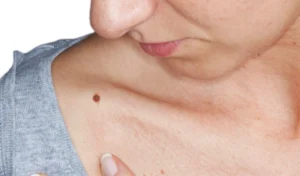 Tẩy nốt ruồi to và lồi có an toàn không?