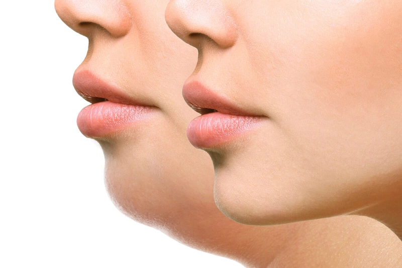 Nên độn cằm hay tiêm filler?