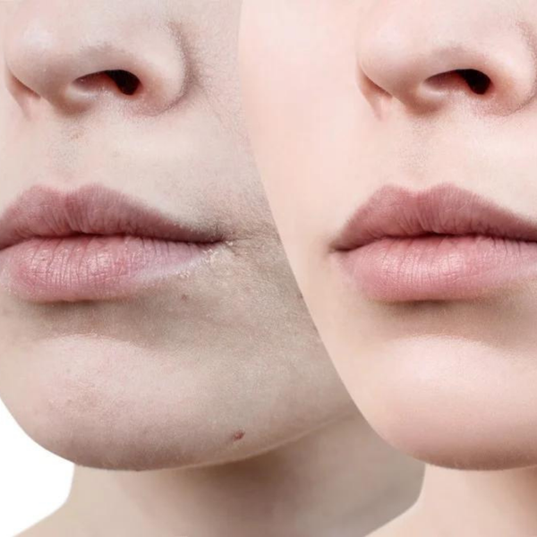 Sai lầm khiến môi thâm trở lại sau khi khử Sai lầm khiến môi thâm trở lại sau khi khử