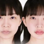 Tiêm filler môi là gì?