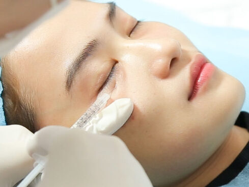 Phun mí kết hợp filler vùng đuôi mắt – thế nào cho hài hòa? 1 Phun mí kết hợp filler vùng đuôi mắt – thế nào cho hài hòa?