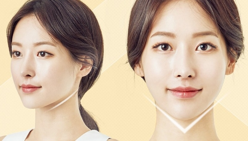 Tiêm filler cằm cần bao nhiêu cc?